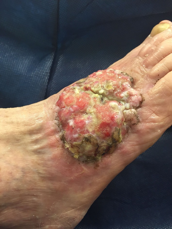 Clinical photograph of a large fungating basal cell carcinoma on the dorsum of the foot before surgery