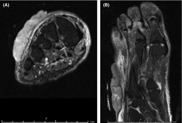 Surgical or intraoperative view of basal cell carcinoma excision on the foot dorsum