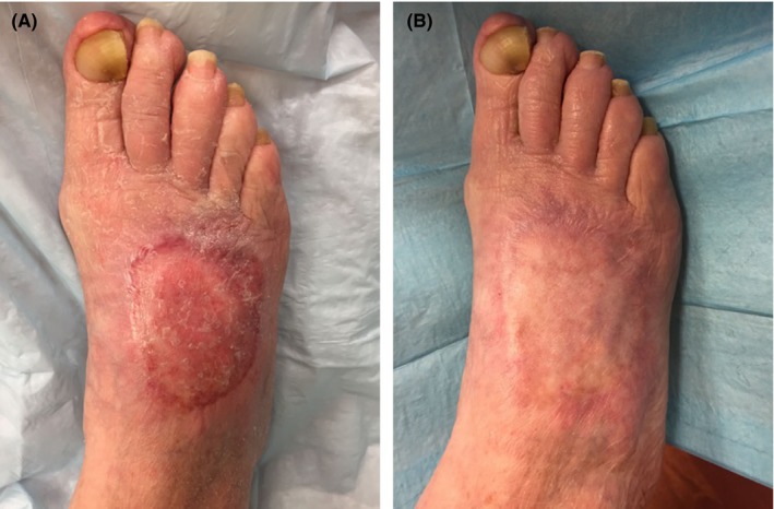 Post-operative view of foot dorsum after basal cell carcinoma excision and reconstruction