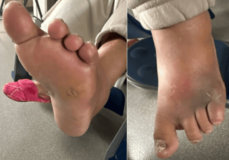 Clinical photograph of a diabetic patient's left foot showing a puncture wound on the lateral forefoot five days after stepping on a nail, with surrounding swelling, discoloration, and signs of deep infection