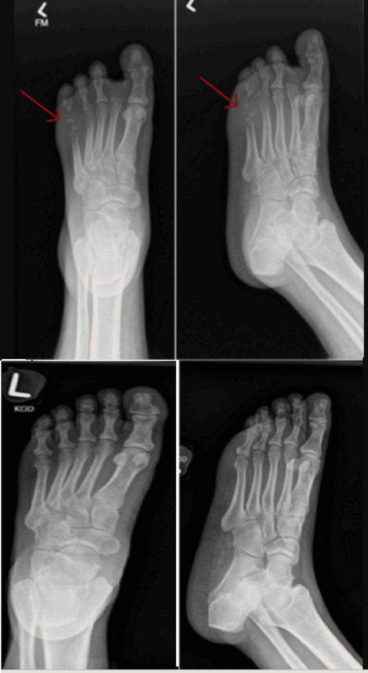 Plain radiographs of the left foot demonstrating osteolysis (bone destruction) of the distal fifth metatarsal — a sign of acute osteomyelitis — with comparison X-rays from 9 years earlier showing normal bone for reference