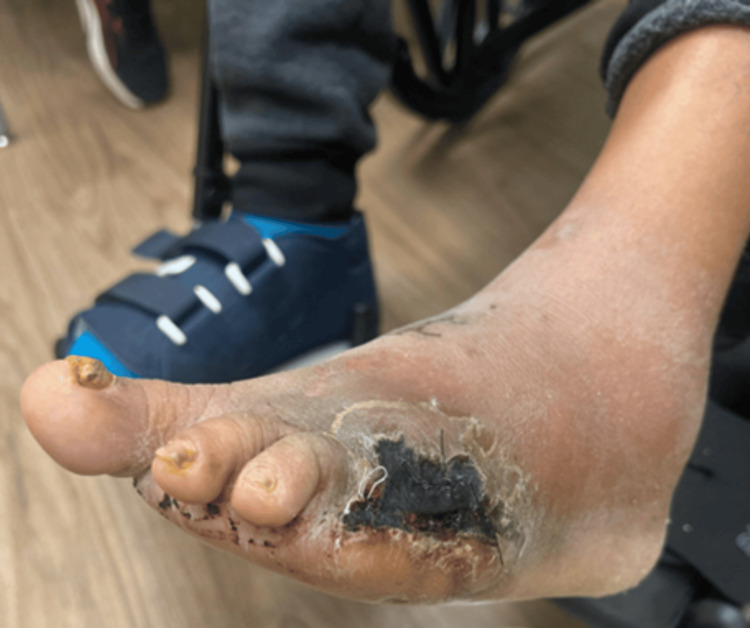 Clinical photograph of the left foot after incision and drainage and ray amputation of the fifth toe and metatarsal, showing the surgical wound during the healing phase