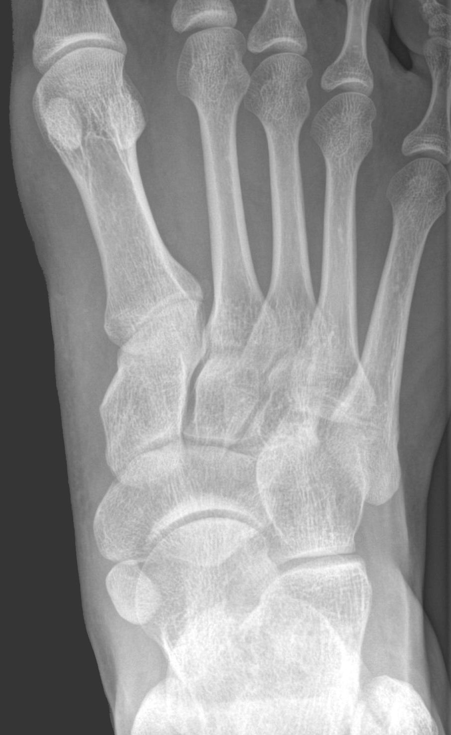 X-ray showing a Type I accessory navicular — a small round ossicle within the posterior tibial tendon, separate from the navicular