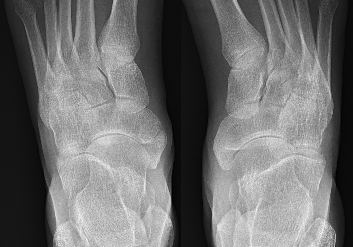 Both feet on dorsoplantar X-ray — the right foot shows a Type 2 accessory navicular (separate ossicle), and the left foot shows a Type 3 (cornuate, fused to the navicular).