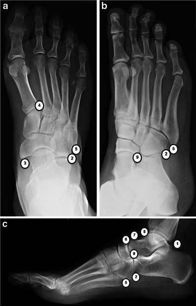 Common accessory ossicles of the foot, shown on three X-ray views (anteroposterior, oblique, and lateral). The numbered locations correspond to frequently seen accessory ossicles — most appear as small, smoothly corticated bones near a normal anatomical structure they're related to. The exact identity of each numbered ossicle is detailed in the original article.