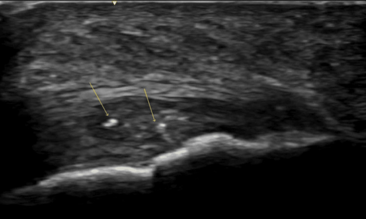Ultrasound of insertional Achilles tendinopathy showing intratendinous calcifications at the heel attachment