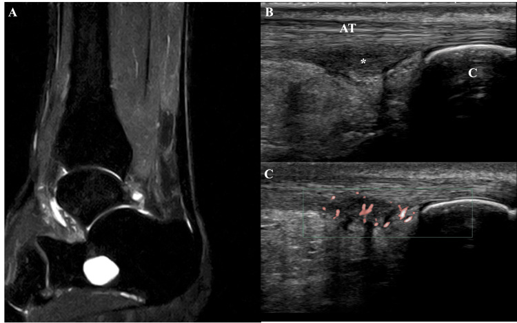 Mid-portion Achilles tendinopathy showing thickened tendon body 2-6 cm above the heel