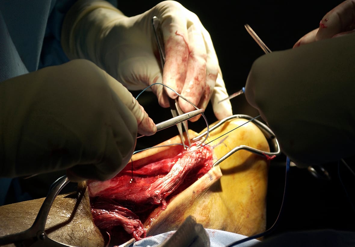 Intraoperative photo of an Achilles tendon repair showing the torn tendon ends sutured back together