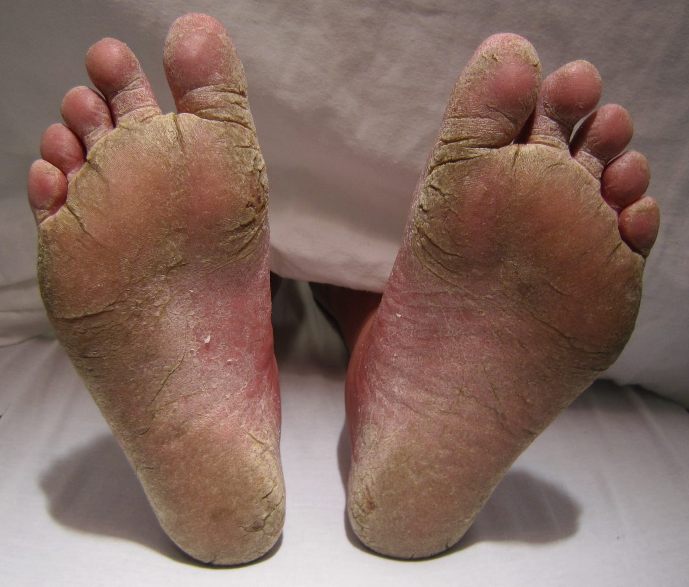 Moccasin-type athlete's foot — diffuse scaling and peeling covering the entire sole and sides of both feet.