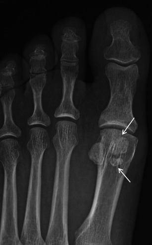 Bipartite hallucal sesamoid on X-ray — the medial sesamoid appears in two pieces. The key clinical question: is this a normal congenital bipartite (in 10–30% of people) or a fracture? A true congenital bipartite has smooth, well-corticated edges that fit together like a puzzle piece. Irregular, jagged edges that don't align well — as shown here — suggest fracture instead.