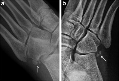 Two-panel X-ray comparison of os peroneum: panel a shows a normal bipartite os peroneum with smooth corticated edges; panel b shows a fractured os peroneum with irregular fragment alignment