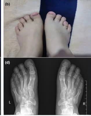 Clinical and radiographic appearance of brachydactyly affecting both feet — top panel shows the external appearance with shortened 4th and 5th toes that ride higher than the neighboring toes; bottom panel shows the corresponding X-ray with shortened 4th and 5th metatarsals