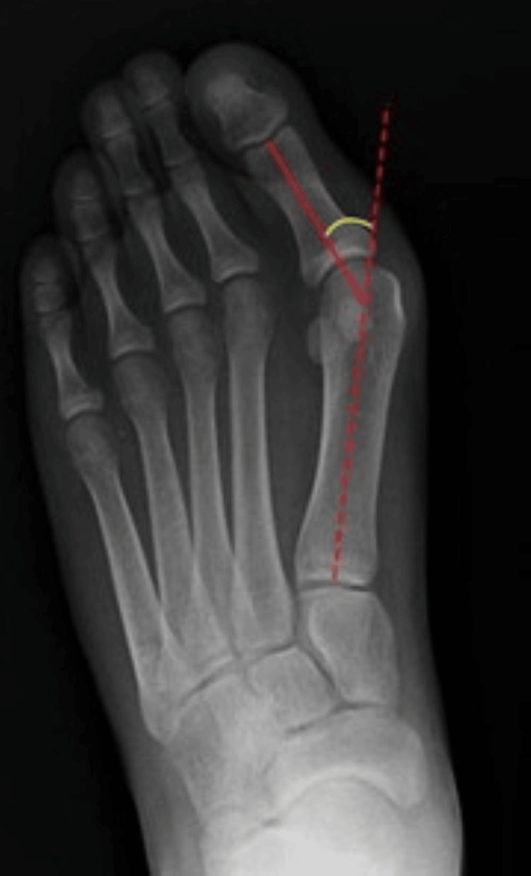 AP X-ray of a foot with hallux valgus (bunion) showing the big toe deviating laterally toward the second toe and the first metatarsal angled medially, with the hallux valgus angle drawn between them in red and yellow