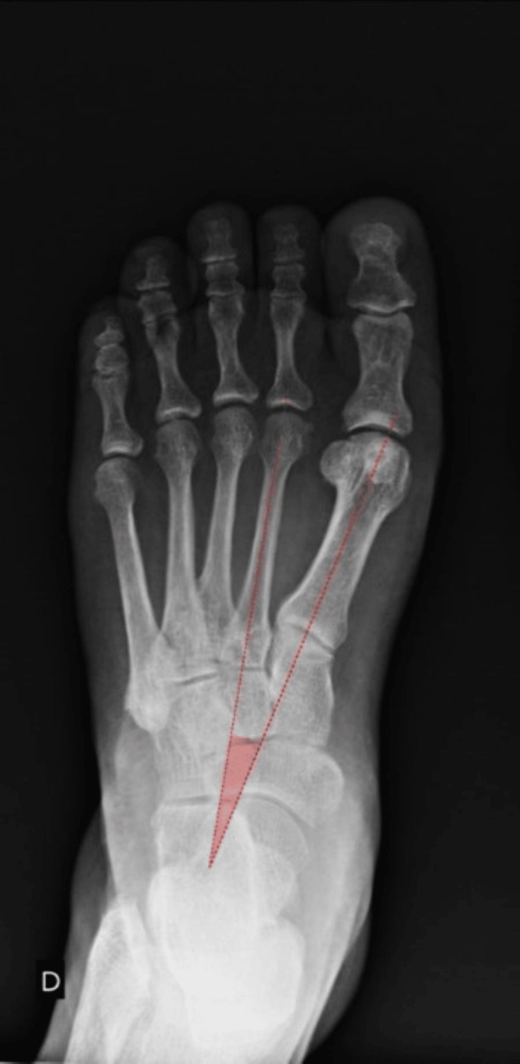 Normal foot AP X-ray showing the big toe and first metatarsal in straight alignment, with the dotted lines representing the long axis of the first metatarsal and second metatarsal showing a small intermetatarsal angle between them