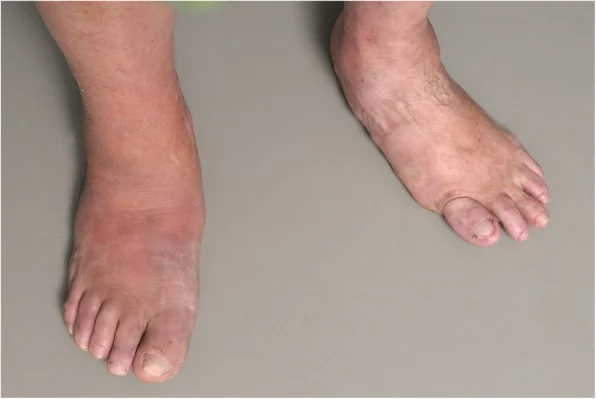 Acute active-phase Charcot foot: the right foot is red, hot, and swollen compared with the left foot.