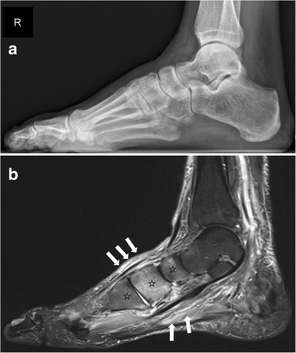 Early active Charcot foot: (a) a lateral x-ray that looks normal, while (b) the MRI STIR sequence already shows bone marrow edema in the midfoot and surrounding soft-tissue edema.