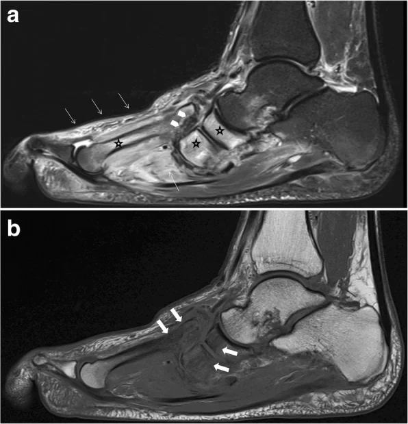 MRI of active Charcot foot in the fragmentation stage, showing dislocation of the metatarsals at the Lisfranc joint and massive bone marrow edema.