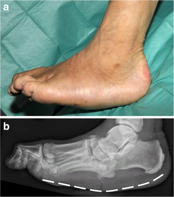 Rocker-bottom deformity of end-stage Charcot foot: (a) clinical photo of the collapsed midfoot, (b) lateral radiograph showing the reversed arch.