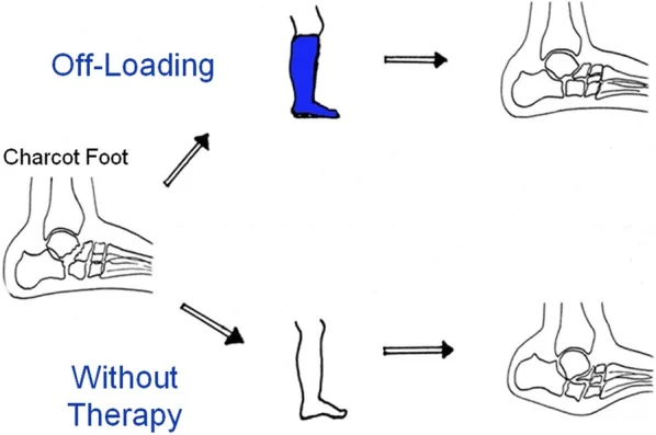 Diagram of off-loading therapy: a Charcot foot treated with a total contact cast heals with the arch preserved, while an untreated foot collapses into deformity.