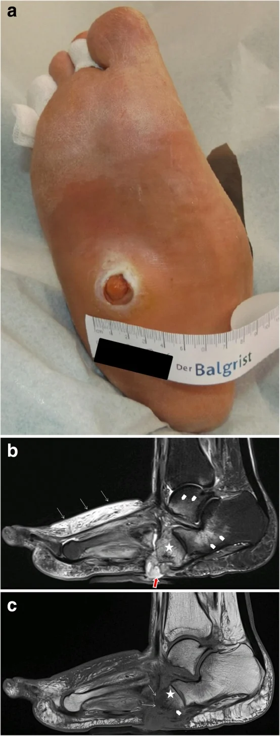 Plantar ulcer beneath the cuboid bone as a complication of rocker-bottom Charcot deformity, with MRI showing spread of infection into the bone.