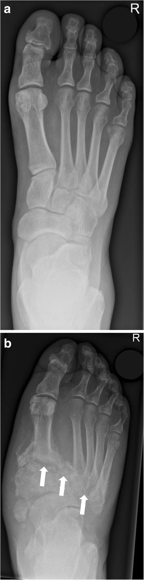 Weight-bearing dorsoplantar foot radiographs, baseline (a) and five months later (b), showing new fractures, subchondral cysts, erosions, and dislocation of the Lisfranc joint.