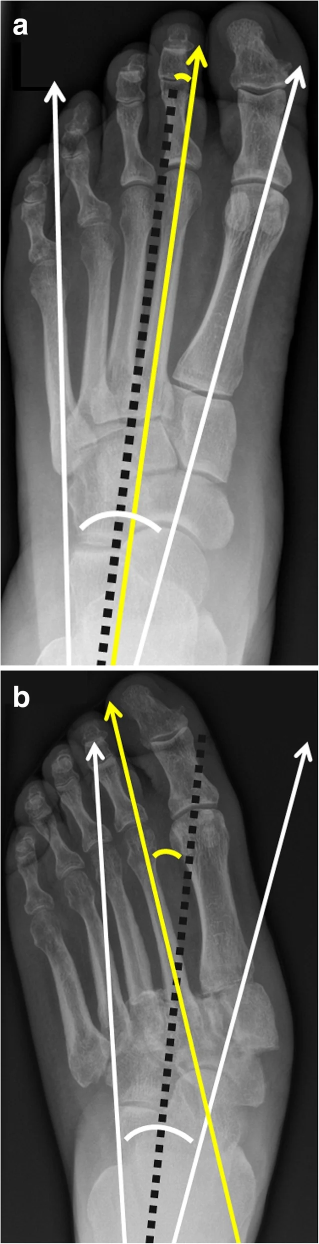 Dorsoplantar foot radiographs, baseline (a) and ten months later (b), showing increasing outward drift (abduction) of the forefoot relative to the hindfoot.
