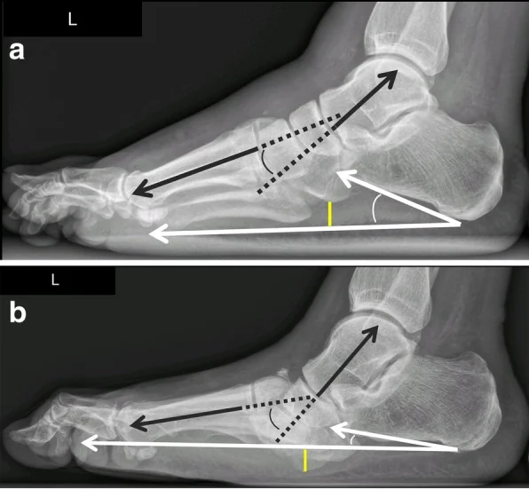 Lateral weight-bearing foot radiographs, baseline (a) and ten months later (b), showing the arch collapsing as Meary's angle increases.