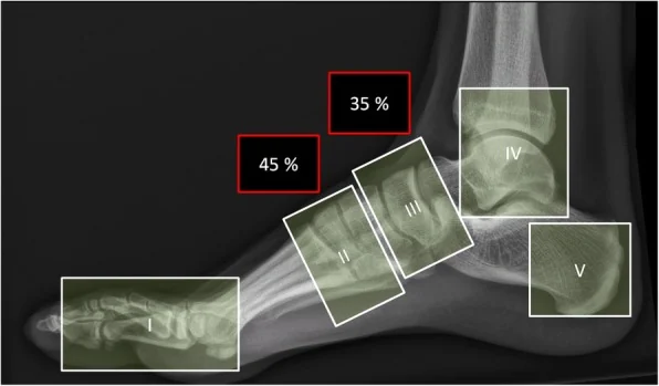 Sanders and Frykberg anatomical classification of Charcot foot, zones I to V from the toe joints to the calcaneus, overlaid on a foot x-ray.