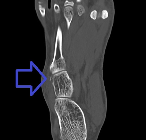 CT scan of the foot showing an avulsion fracture of the cuboid that was not visible on the initial X-ray