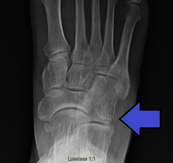Avulsion fracture of the cuboid on X-ray — a fragment of bone has been pulled away by ligamentous tension; this pattern is often missed on the initial reading.