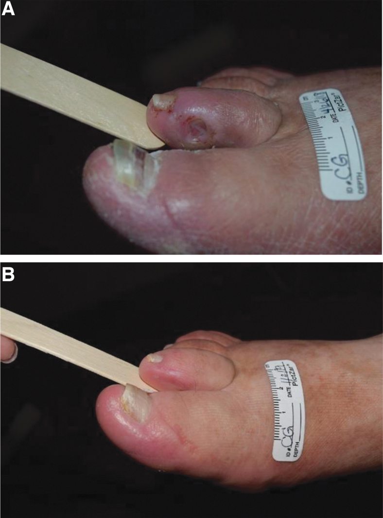 Wagner Grade 1 diabetic foot ulcer caused by shoe friction. Left: at presentation. Right: after offloading and serial debridement.