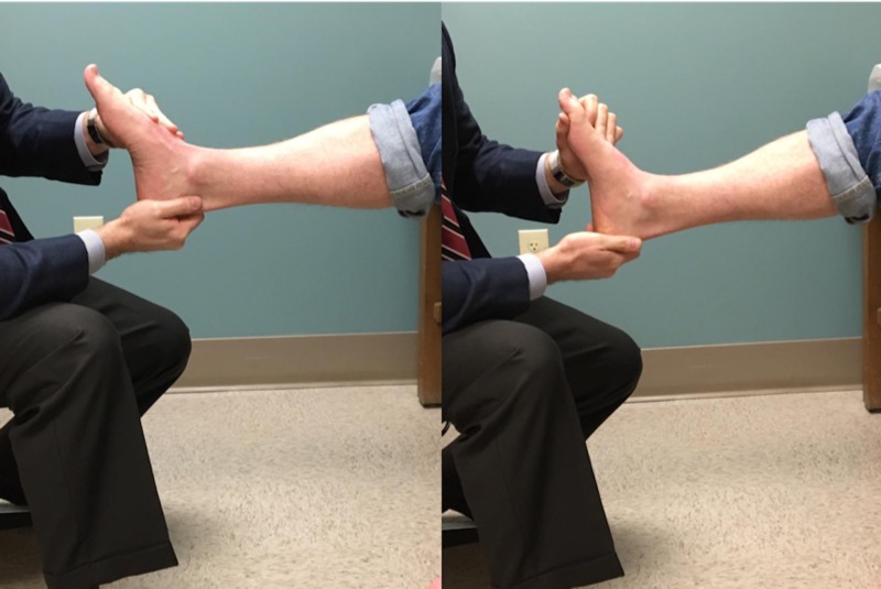 Two-hand Silfverskiöld test technique. Locking the subtalar and talonavicular joints isolates true ankle dorsiflexion measurement and distinguishes gastrocnemius tightness from a deeper gastroc-soleus contracture.