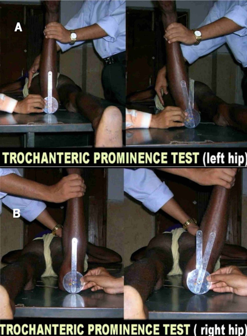 Clinical exam showing increased internal hip rotation in femoral anteversion, child lying prone with hips internally rotated
