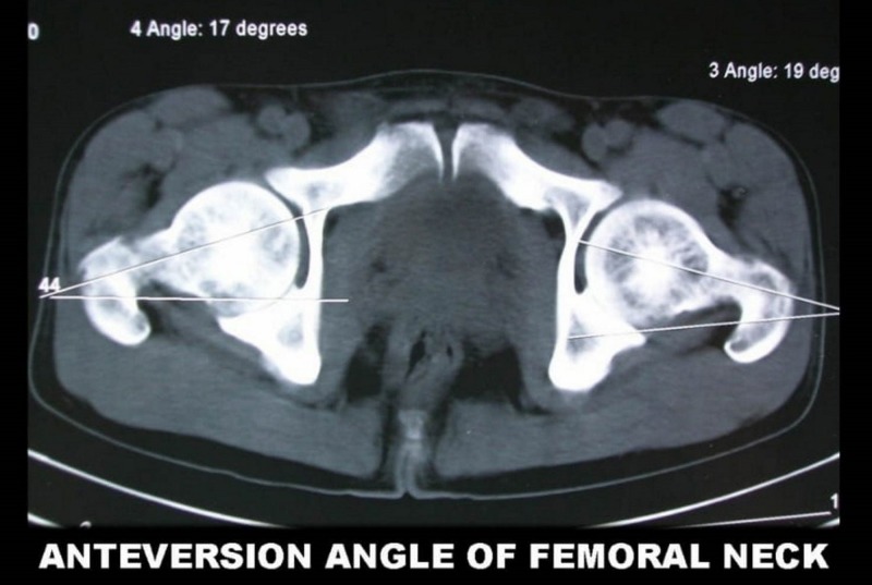 CT scan measurement of the femoral neck-shaft angle showing increased anteversion