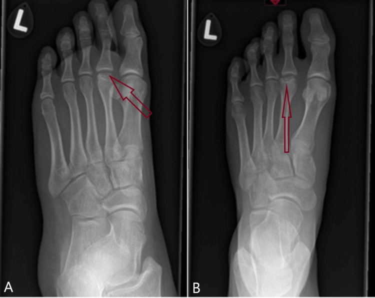 Freiberg's disease — X-ray showing flattening of the second metatarsal head, the characteristic finding.
