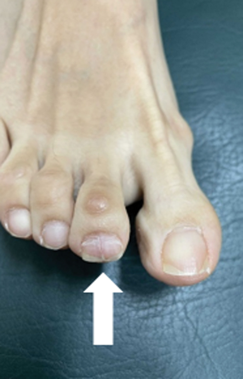 Clinical photograph of subungual glomus tumor of the second toe