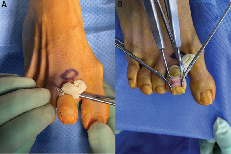 Close-up view of glomus tumor under the toenail