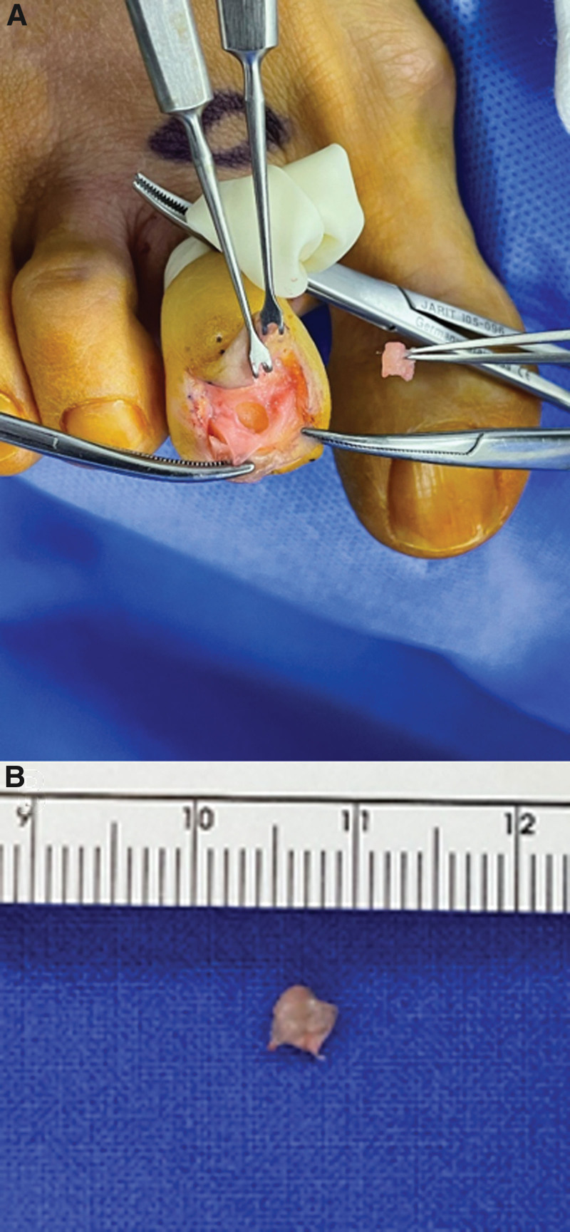 Imaging study (MRI) showing glomus tumor in the second toe