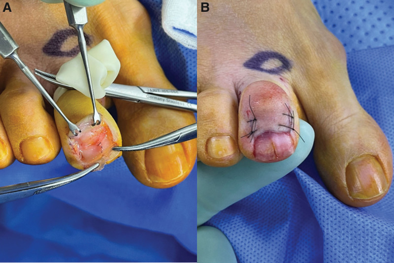 Intraoperative photograph during nail-preserving excision of glomus tumor