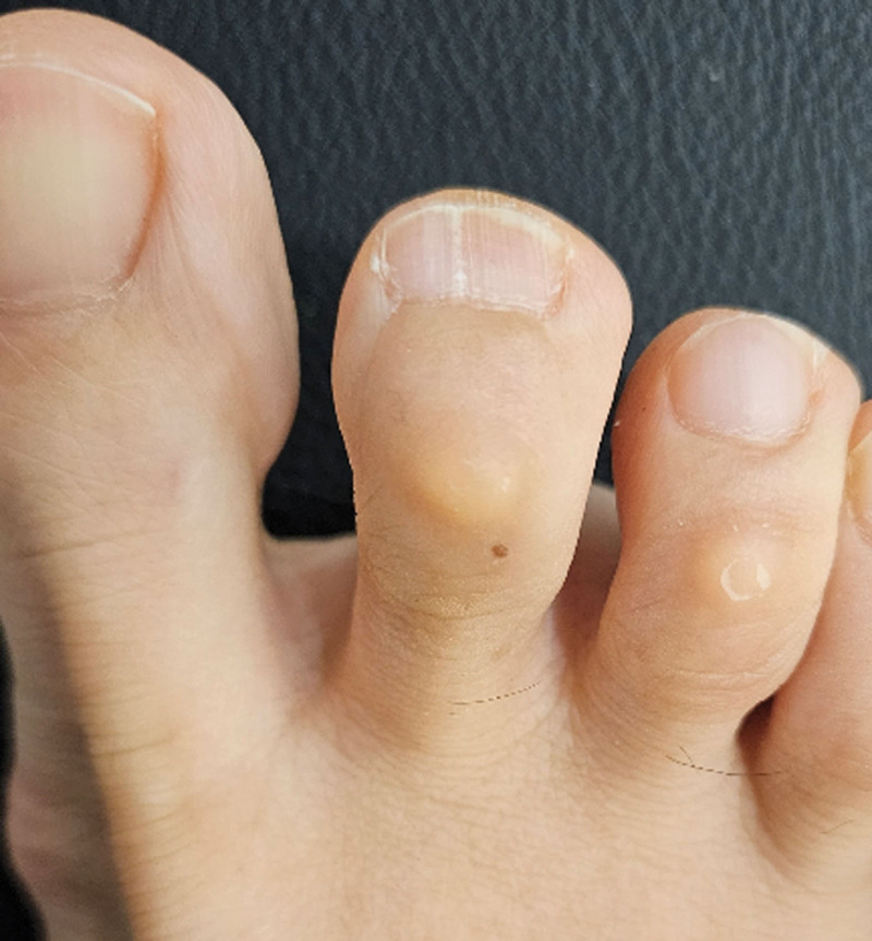 Post-operative outcome after glomus tumor excision