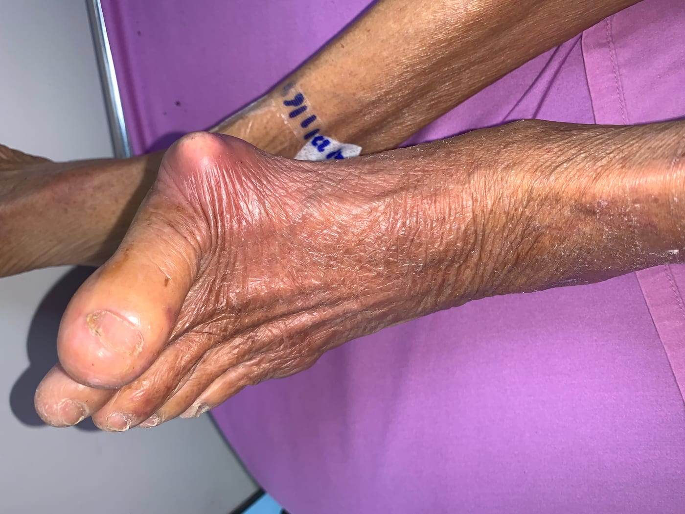 Tophaceous gout affecting the left first metatarsophalangeal joint.