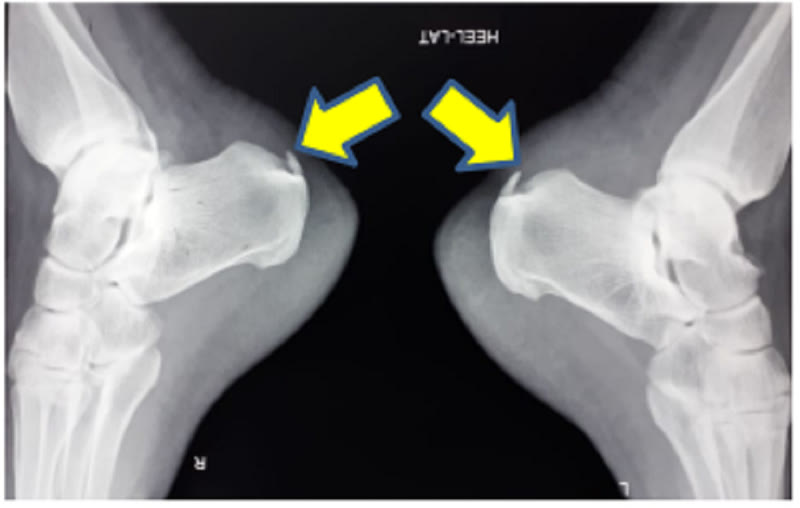 Bilateral lateral X-rays of both heels showing posterior calcaneal prominence in Haglund's deformity