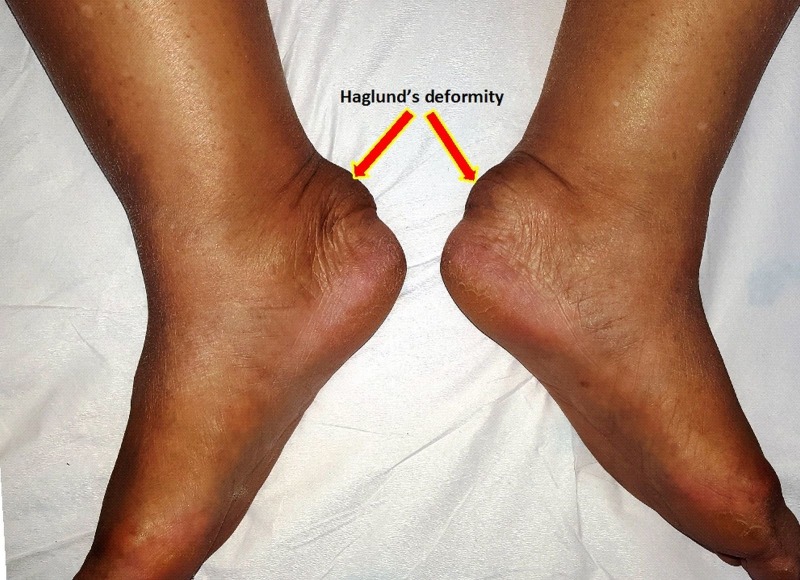Bilateral Haglund's deformity — clinical photograph showing the prominent posterior heel swelling ('pump bump') over both heels.