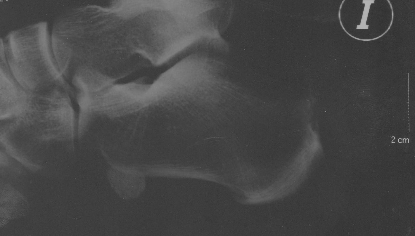 Lateral foot X-ray showing Haglund's deformity with posterior calcaneal prominence
