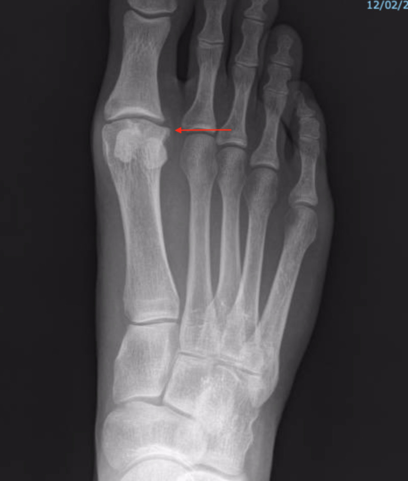 AP X-ray of the foot showing hallux rigidus with joint-space narrowing and osteophyte formation at the first MTP joint