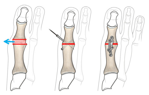 Diagram of first MTP joint fusion (arthrodesis) showing optimal joint position at 5–15 degrees of valgus and 10–20 degrees of dorsiflexion