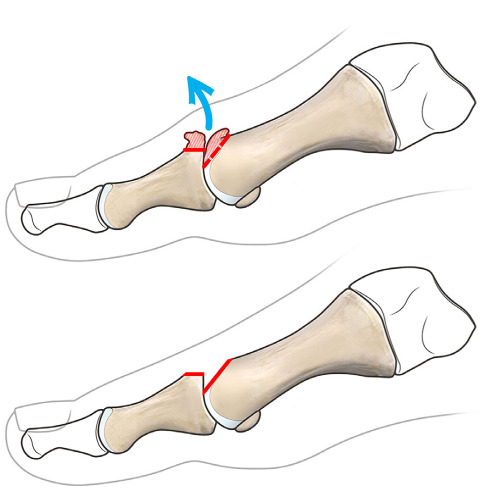 Diagram of cheilectomy showing 25–30% dorsal resection of the first metatarsal head and removal of dorsal osteophytes