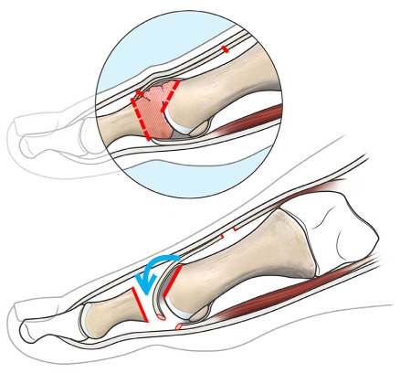 Diagram of Hamilton arthroplasty showing dorsal capsular flap including the extensor hallucis brevis tendon, sutured to the stumps of the flexor hallucis brevis