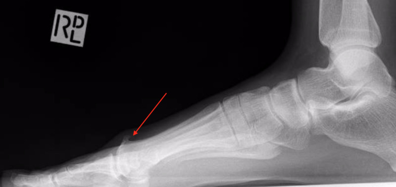 Lateral X-ray of hallux rigidus — note the dorsal osteophyte (bone spur) over the head of the first metatarsal, the hallmark radiographic finding.