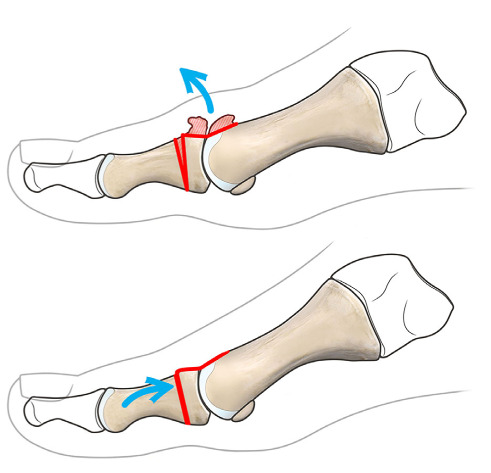 Diagram of Moberg osteotomy — dorsal closing wedge cut in the proximal phalanx of the great toe